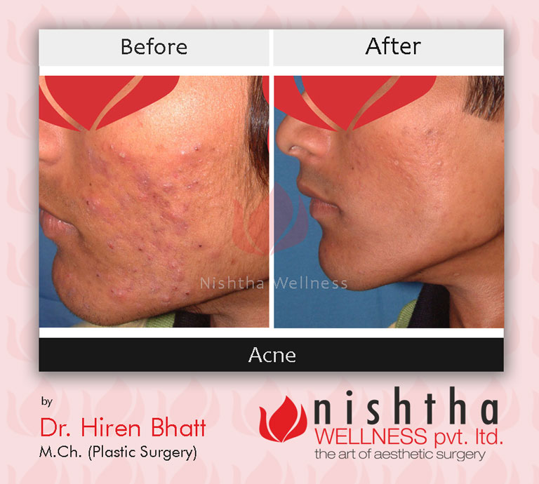 acne-before-after-case-1-side-view-nishtha-wellness