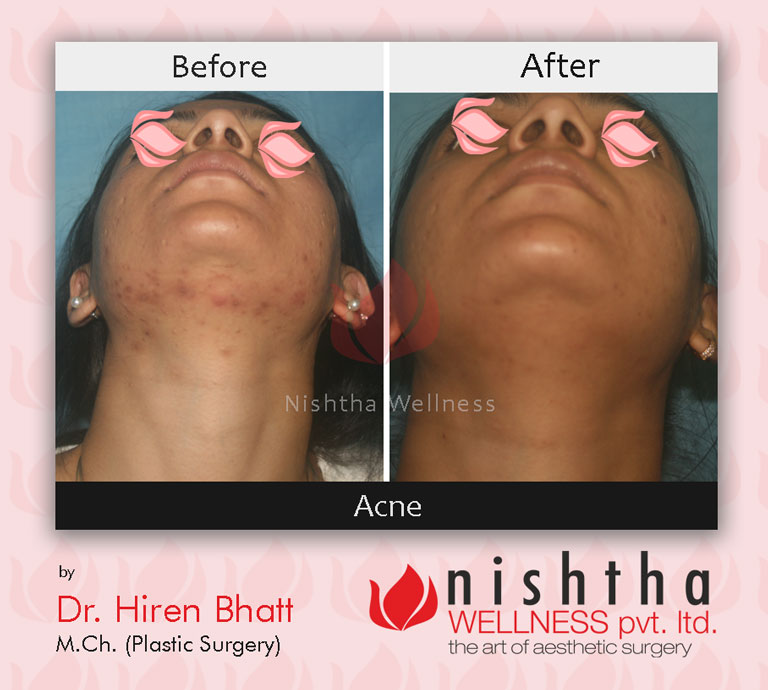 acne-before-after-case-2-bottom-view-nishtha-wellness