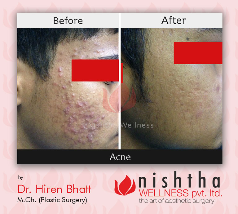 acne-before-after-case-3-side-view-nishtha-wellness
