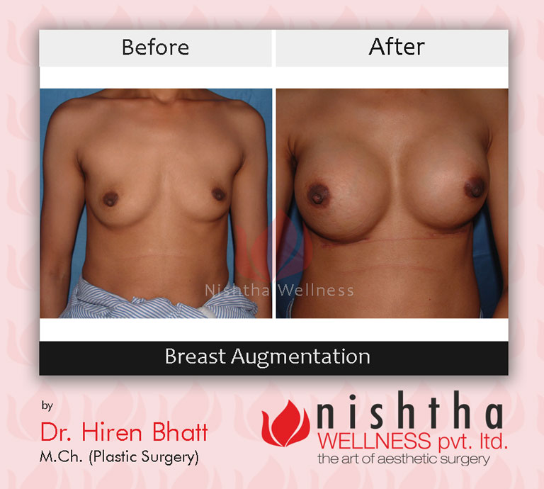 breast-augmentation-before-after-case-1-front-view-nishtha-wellness