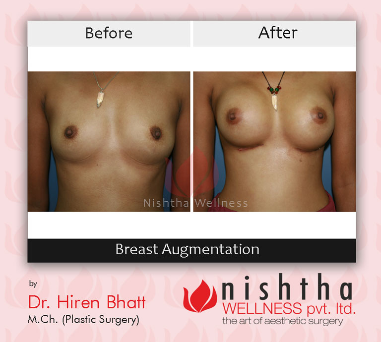 breast-augmentation-before-after-case-2-front-view-nishtha-wellness