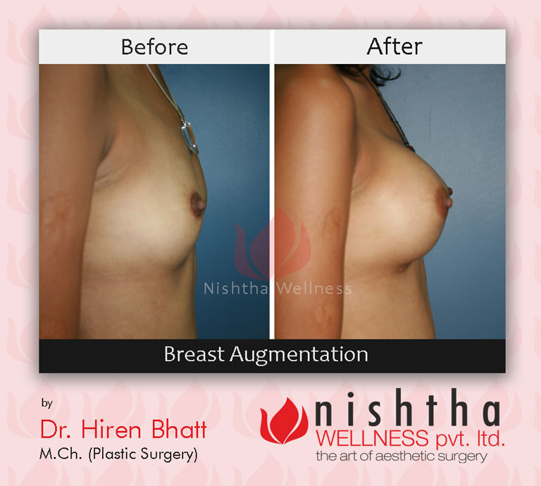 breast-augmentation-before-after-case-2-side-view-nishtha-wellness