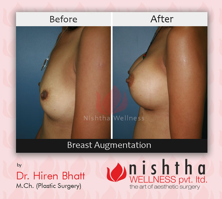 breast-augmentation-before-after-case-2-side-view-nishtha-wellness1