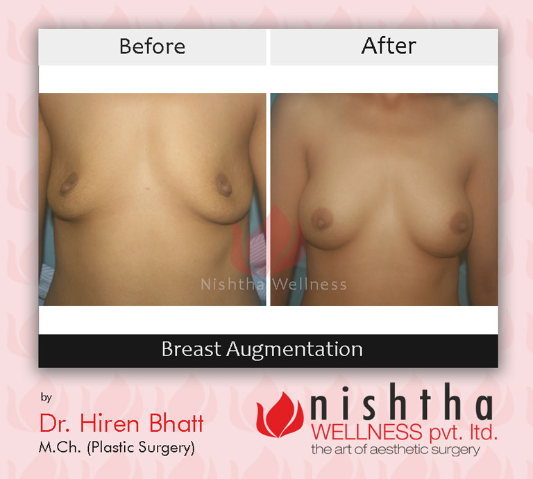 breast-augmentation-before-after-case-4-front-view-nishtha-wellness (1)