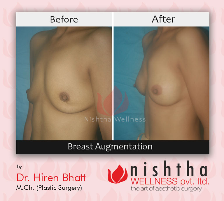 breast-augmentation-before-after-case-4-side-view-nishtha-wellness1