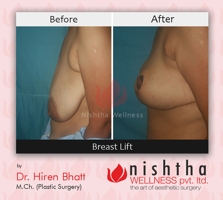 breast-lift-before-after-case-1-side-view-nishtha-wellness1
