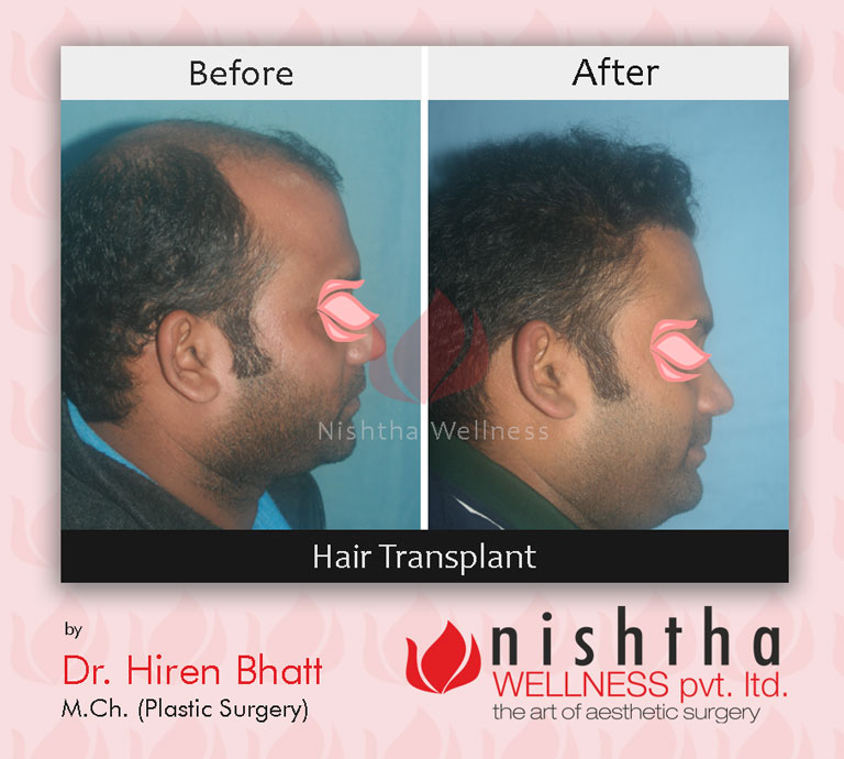 hair-transplant-before-after-case-1-side-view-nishtha-wellness