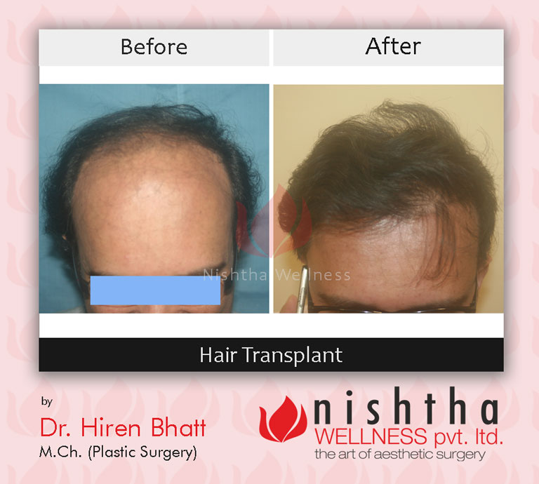 hair-transplant-before-after-case-6-front-view-nishtha-wellness