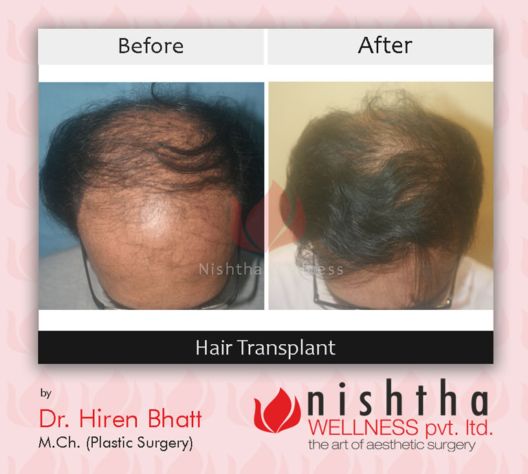 hair-transplant-before-after-case-6-top-view-nishtha-wellness