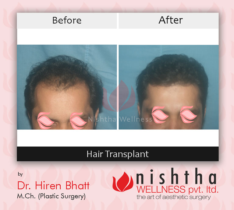 hair-transplant-before-after-case-7-side-view-nishtha-wellness