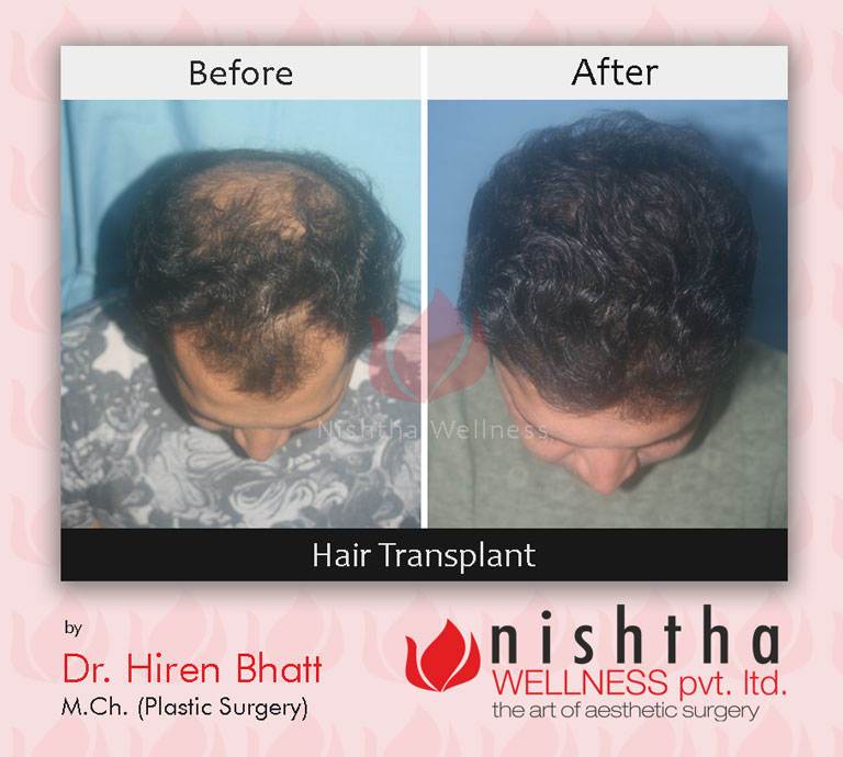 hair-transplant-before-after-case-7-top-view-nishtha-wellness