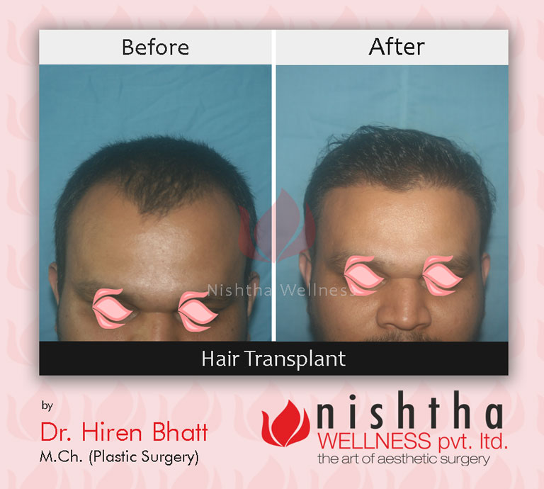 hair-transplant-before-after-case-8-front-view-nishtha-wellness