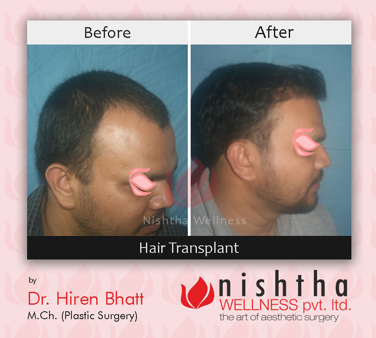 hair-transplant-before-after-case-8-side-view-nishtha-wellness