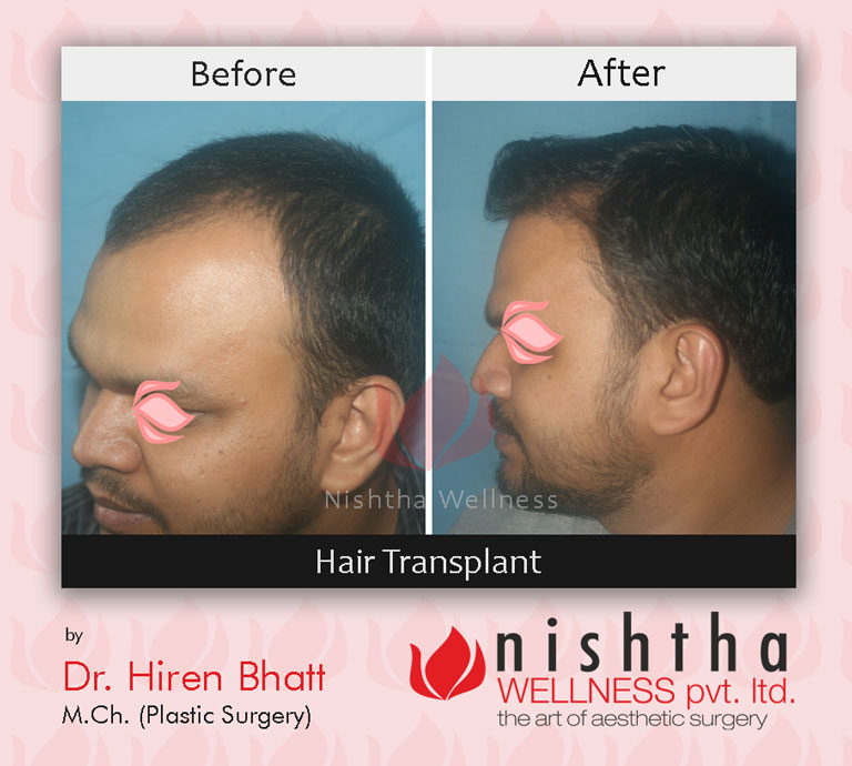 hair-transplant-before-after-case-8-side-view-nishtha-wellness1